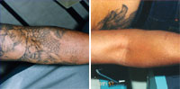 tattoo removal photo white plains westchester